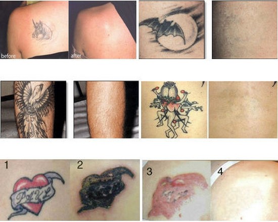 Usunięcie tatuażu maszynowego treatment.jpg
