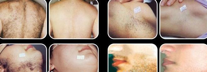 Skin clinic 1800 W IPL beauty equipment for hair removal / IPL beauty machine For permanent hair removal